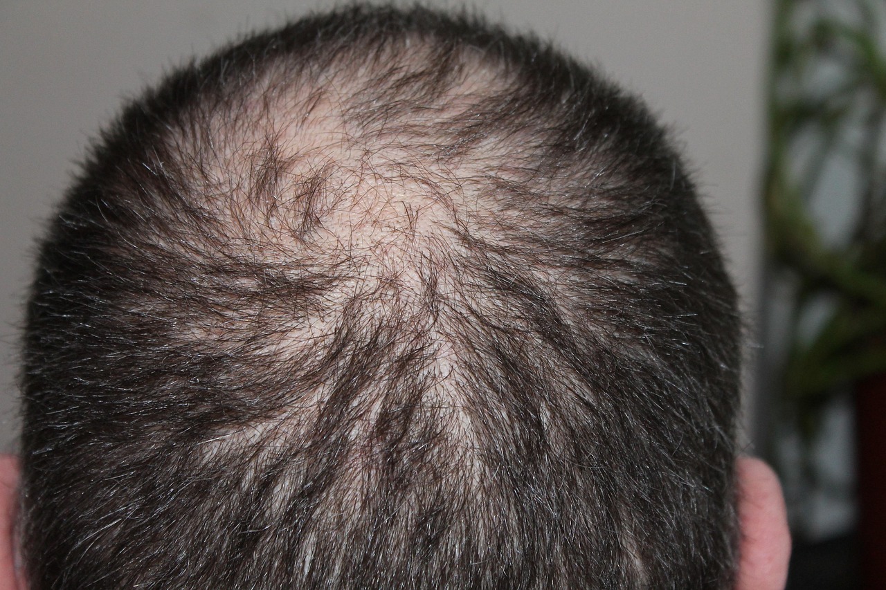 hair loss blog